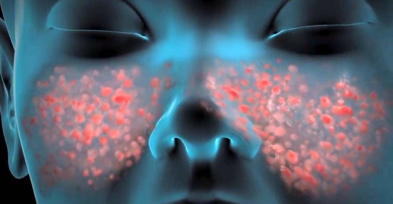 紅斑狼瘡最新消息，研究突破與未來治療方向