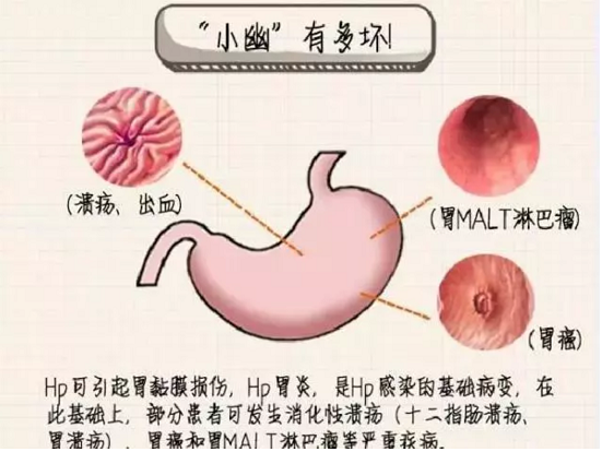 最新幽門桿菌四聯(lián)療法，治療幽門螺桿菌感染的新選擇